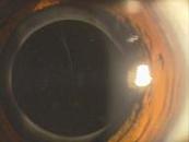 円形の前嚢切開（CCC)内に挿入された眼内レンズ（IOL)です。